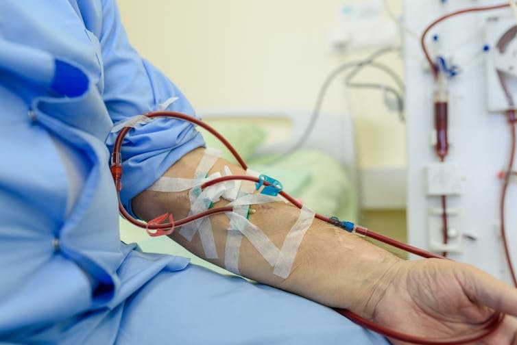 Person holding dialysis at the hospital, attached to the rig with dialysis catheter