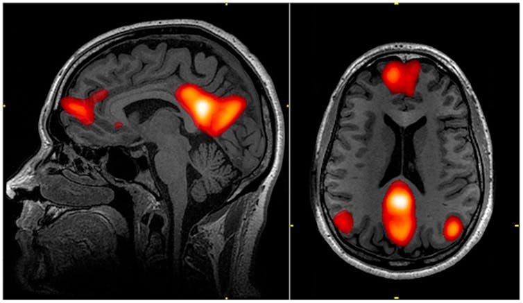 A medical scan of the brain showing regions at the front and back lit up.