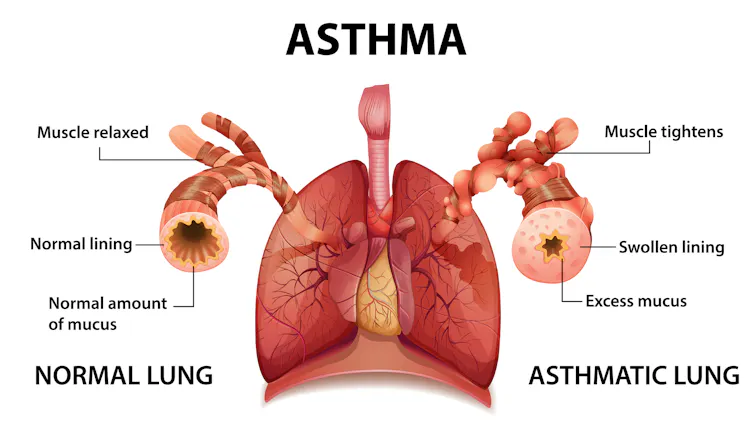 Diagram shows the difference between a normal lung and asthmatic lung, with constricted airways.