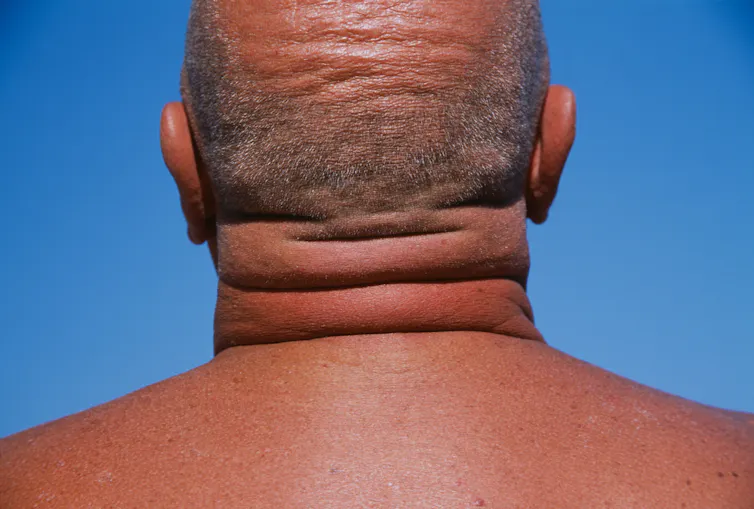 Rear view of a man with fat folds around his neck.