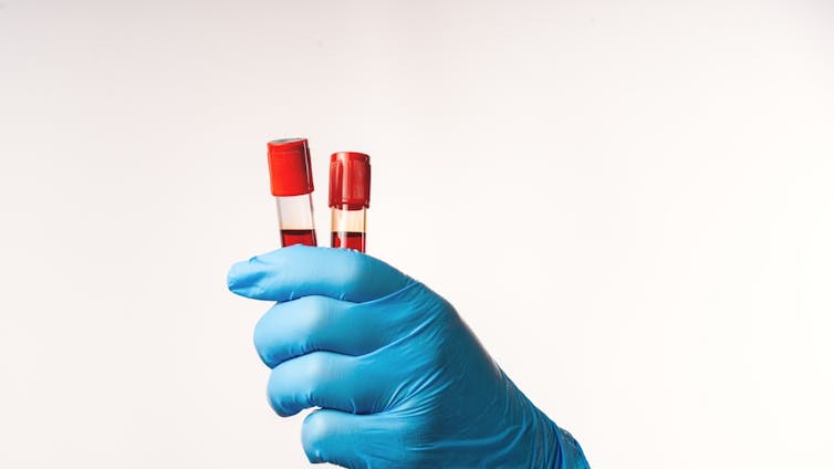 A hand in a blue latex glove holding two phials of blood.