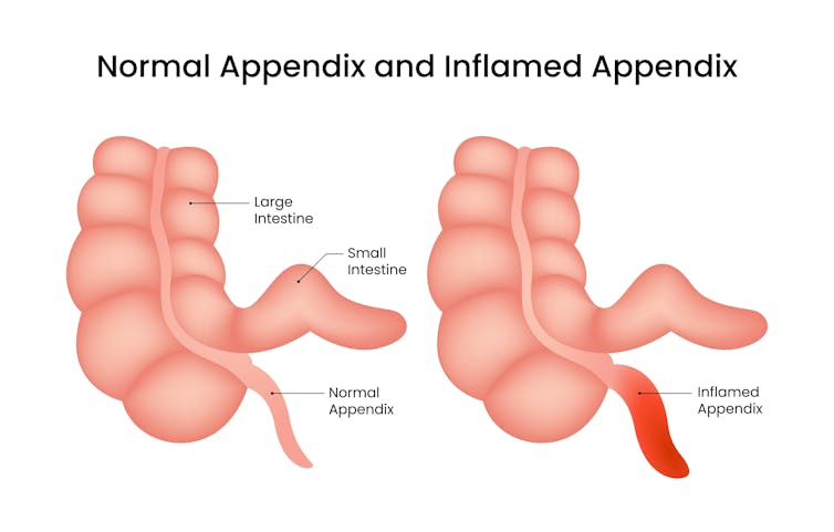 An illustration of a normal appendix versus an inflamed appendix.