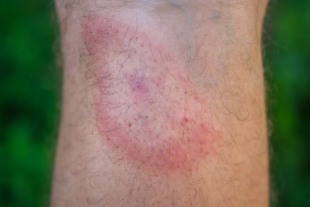 Qu Bicho Te Ha Picado Garrapata Chinche O Mosquito Diario Sanitario qu bicho te ha picado garrapata chinche o mosquito diario sanitario