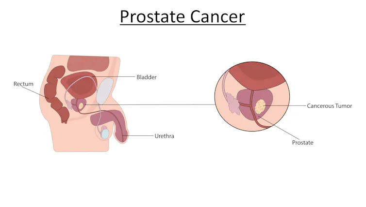 Gráfico de câncer de próstata