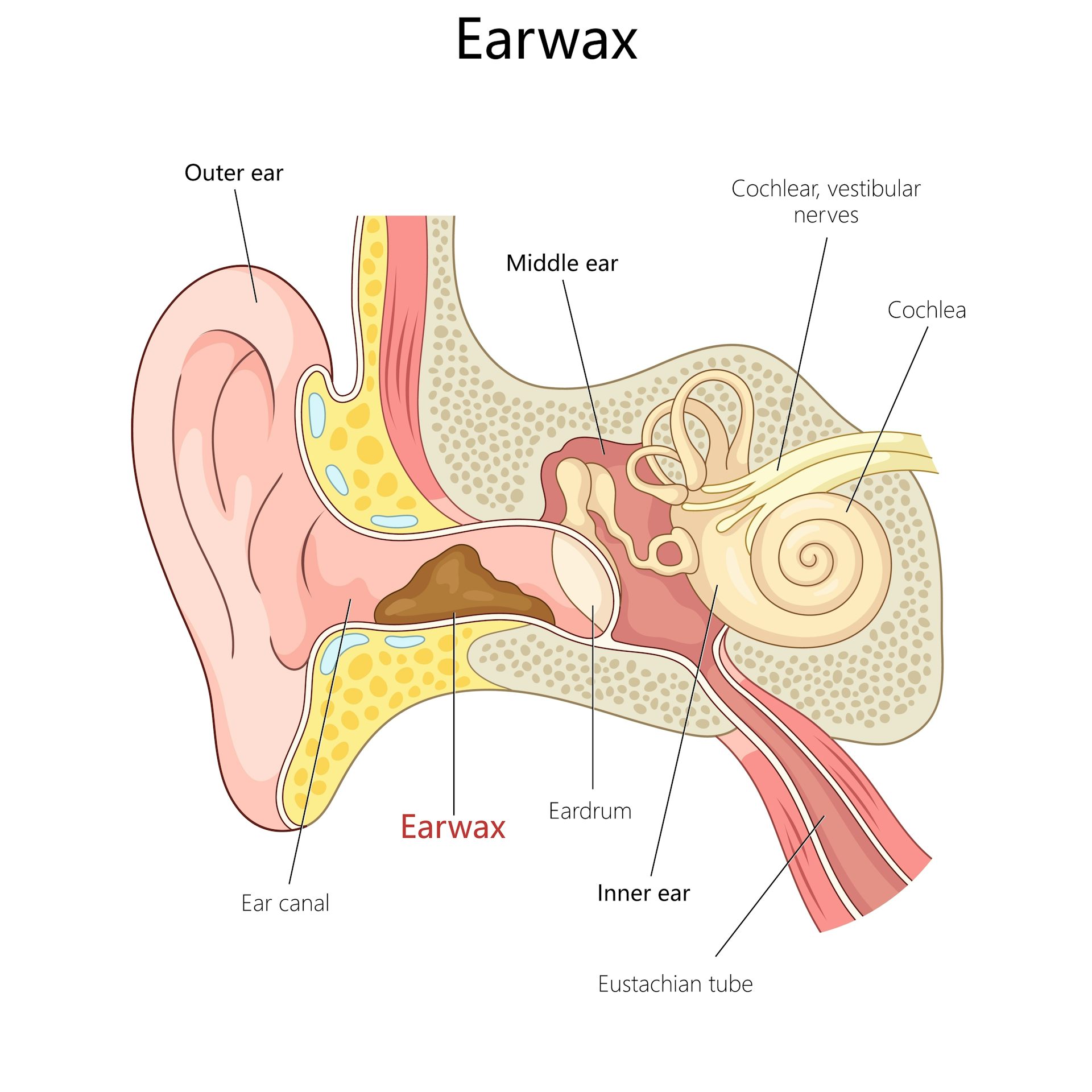 Diagram showing earwax in the ear canal.