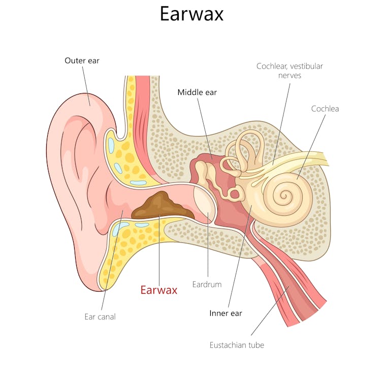 Diagram showing earwax in the ear canal.