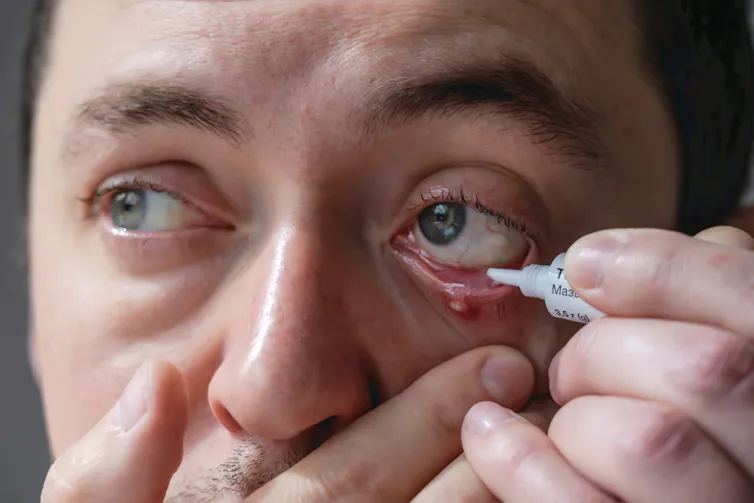 A man uses an eye ointment to treat a stye on his lower lash line.