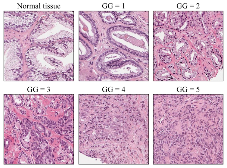 Diagram of prostate cancer tissue grade groups from normal to grade 5, showing increasingly little gland formation