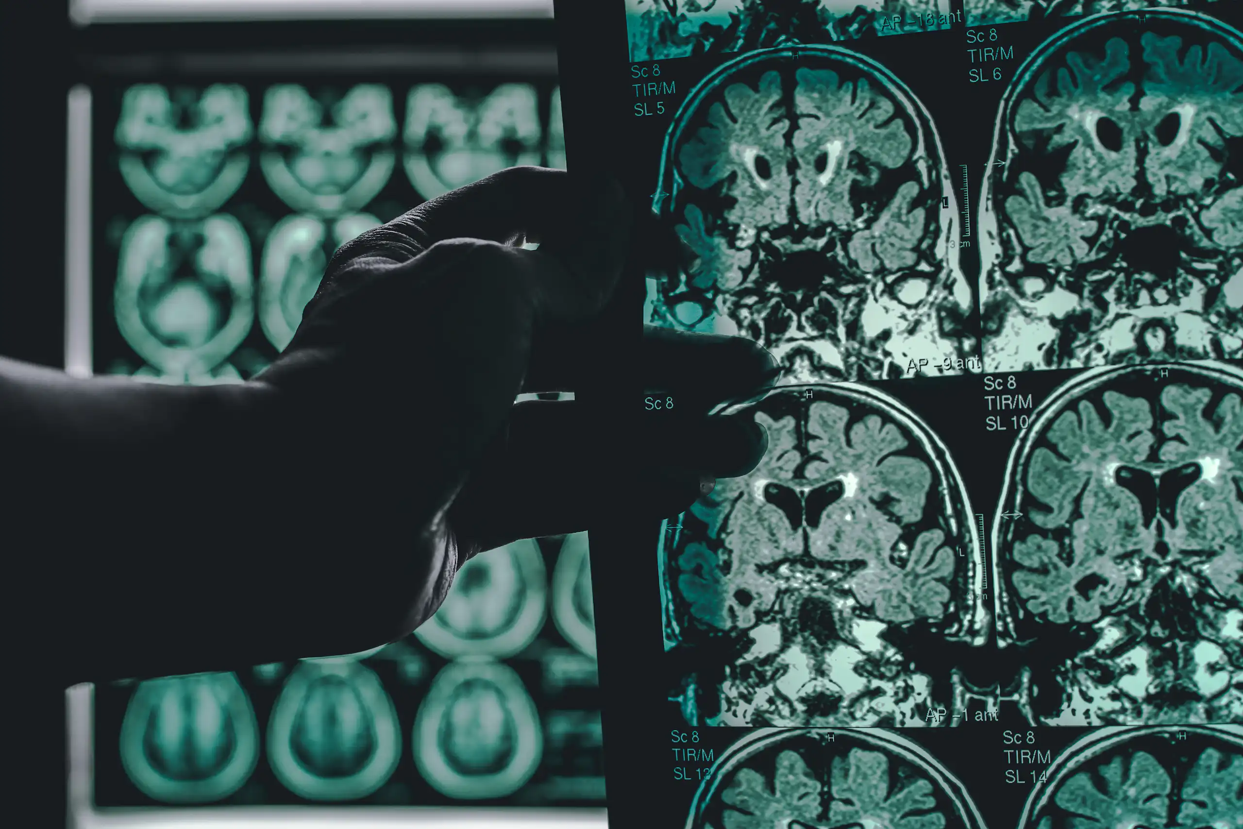 A doctor holding up MRI scans of a brain of someone with Alzheimer's