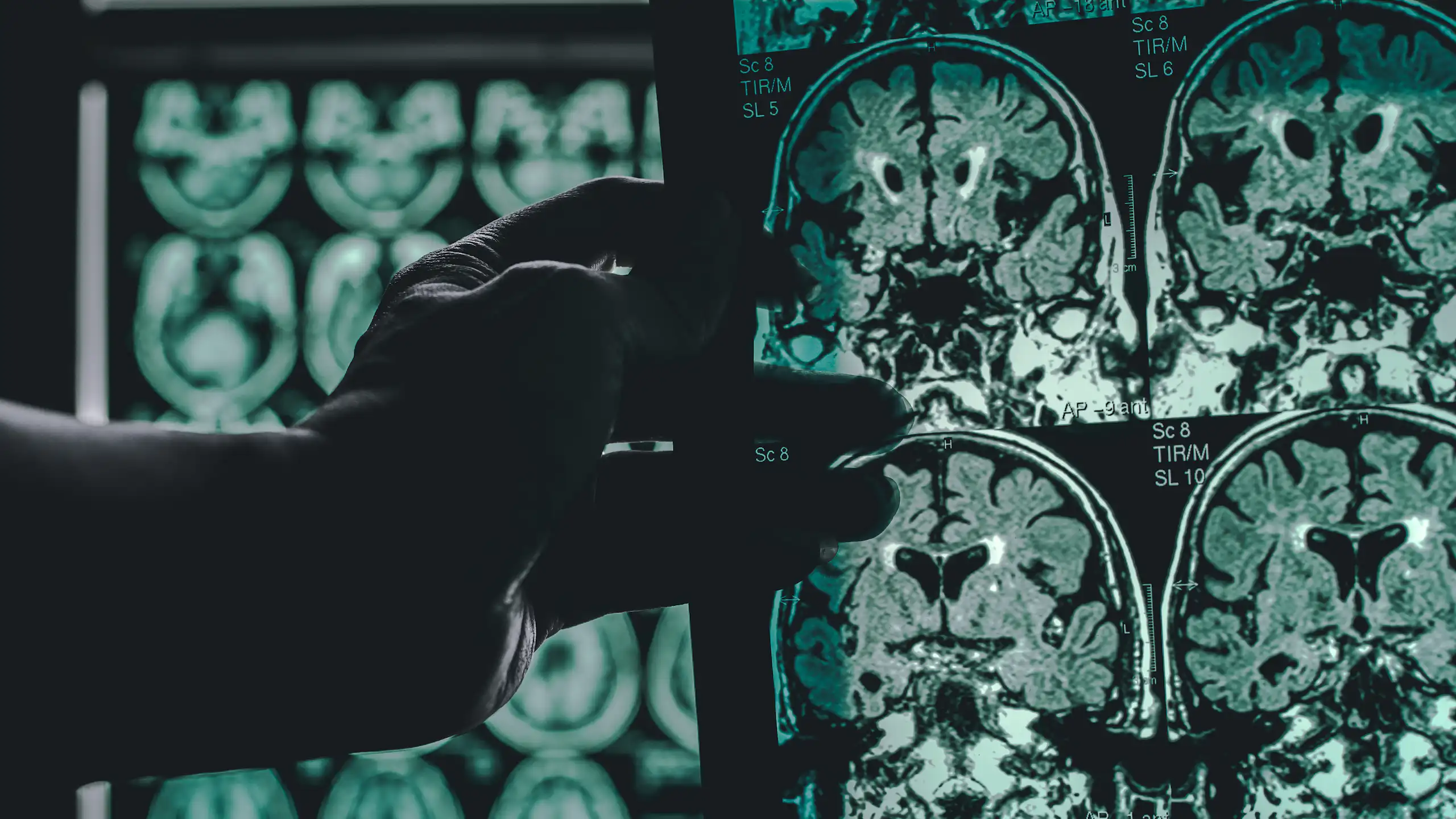 A doctor holding up MRI scans of a brain of someone with Alzheimer's