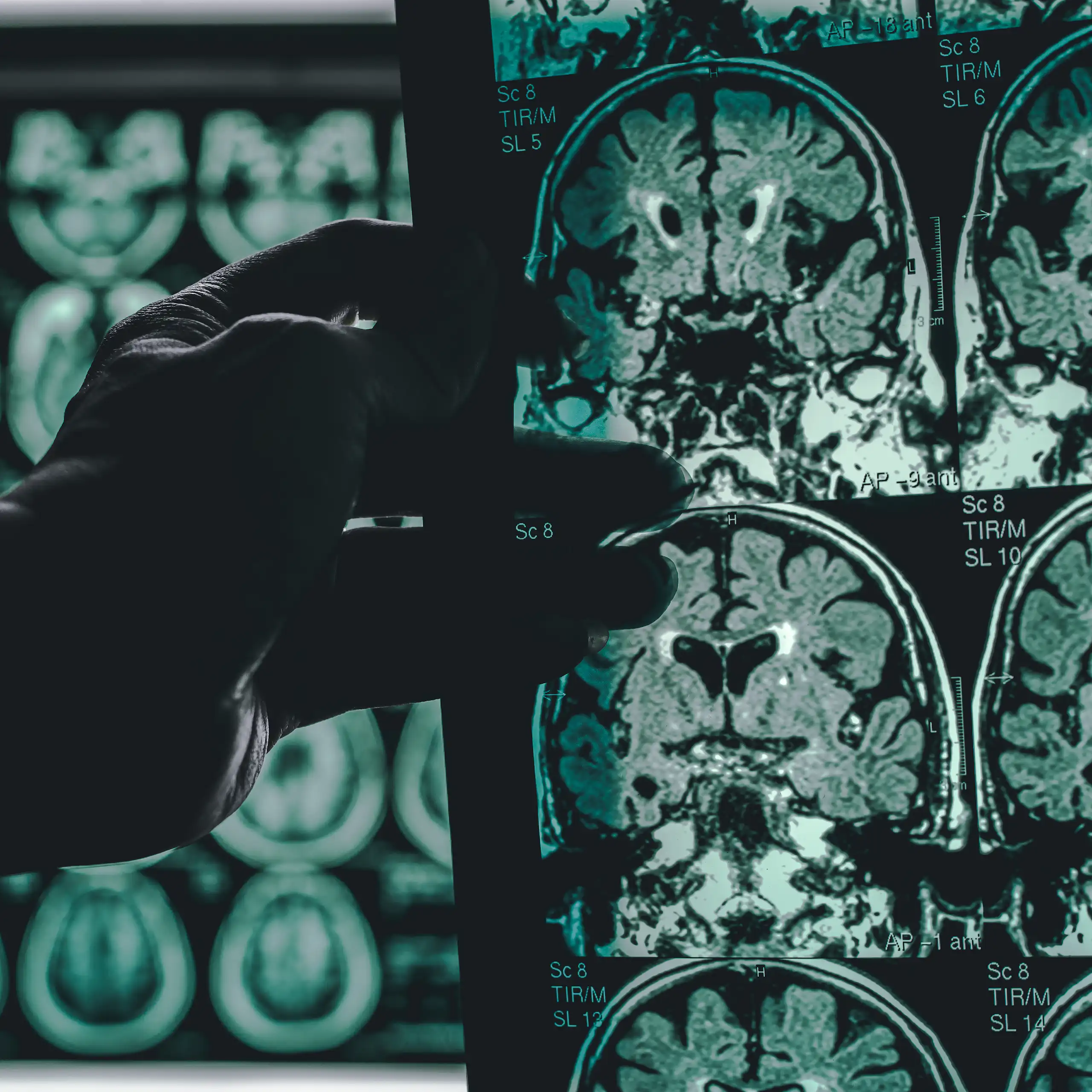 A doctor holding up MRI scans of a brain of someone with Alzheimer's