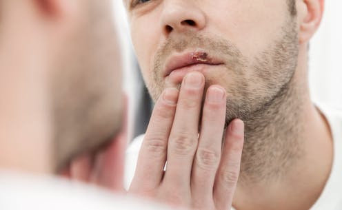 Could cold sores increase the risk of Alzheimer’s disease? A new study is no cause for panic