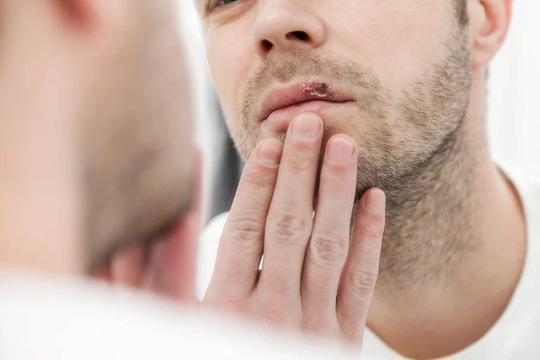 A man looks at a cold sore on his upper lip in the mirror.
