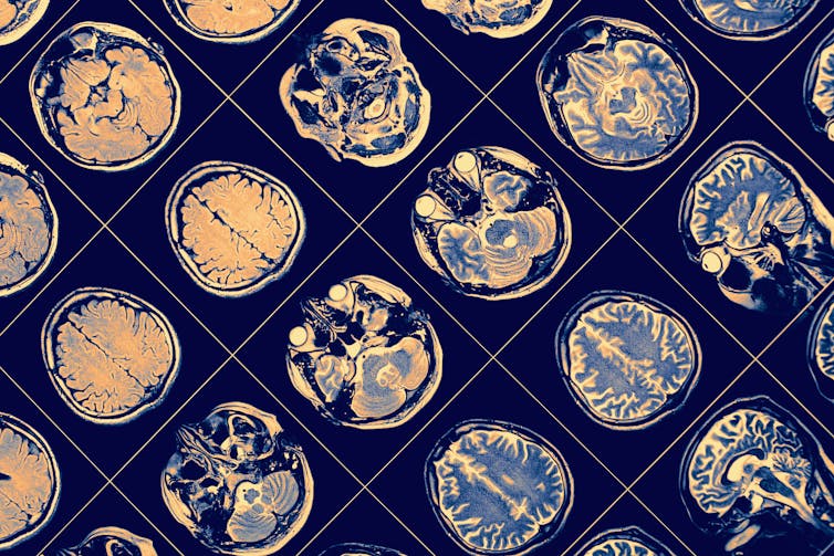 MRI photos of the human brain.