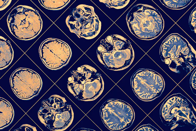 MRI images of the human brain.