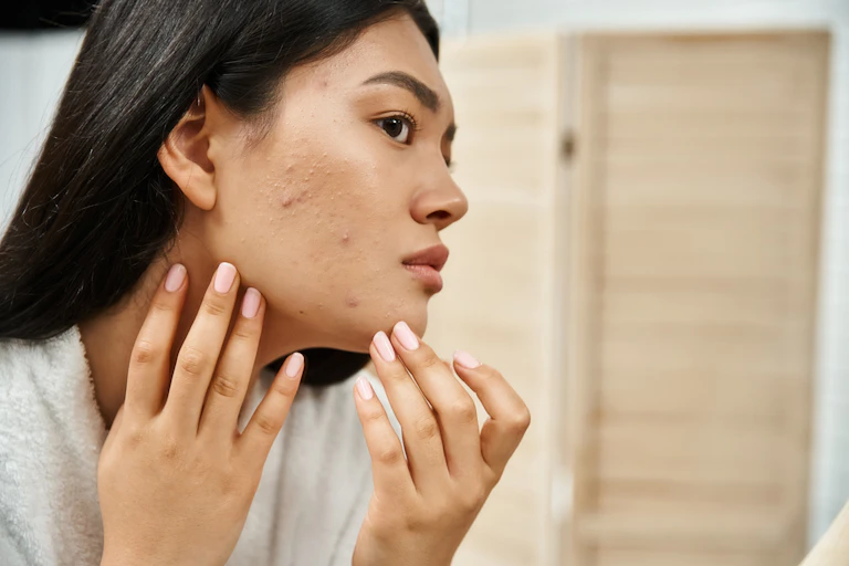 Young woman looks at acne in mirror.