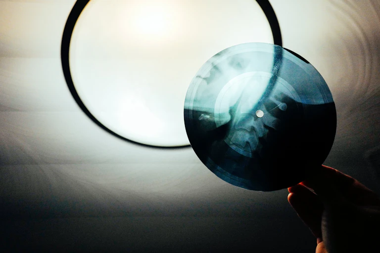A hand holds X-ray film of a spine that's been cut into a circle.