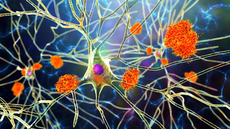 A 3D illustration showing amyloid plaques in brain tissue.