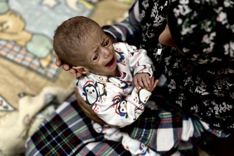 Wasted malnourished baby wails in mother's arms.