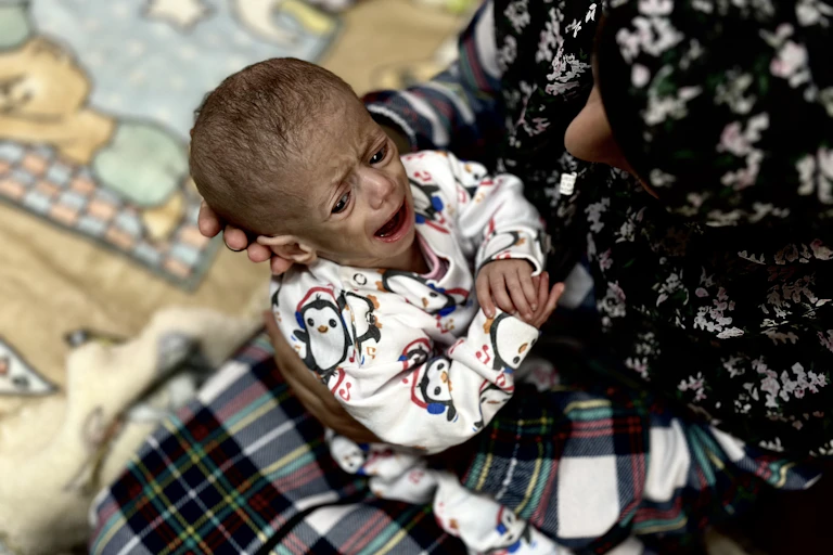 Wasted malnourished baby wails in mother's arms.