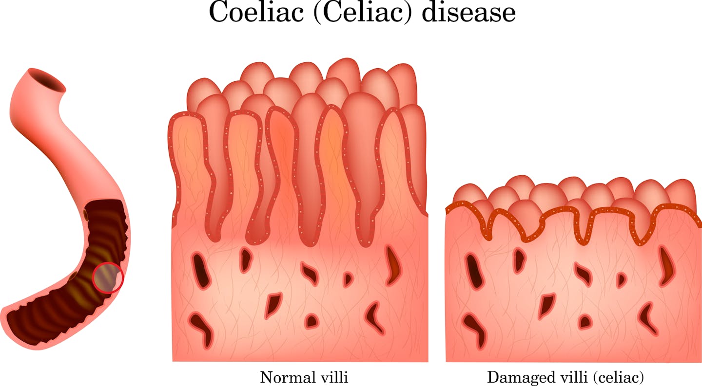 Diagram shows healthy villi in the small intestine versus villi damaged by coeliac disease.