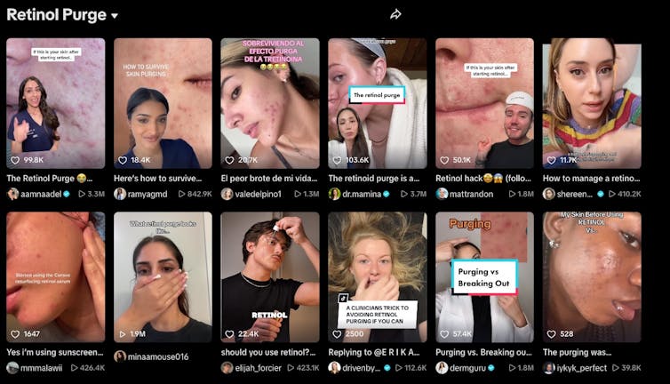 Screenshot of TikTok videos about retinol purge.