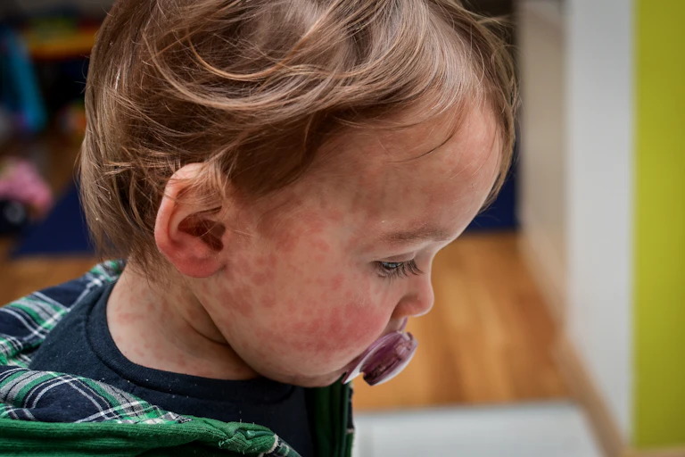 A small child with a measles rash on their face.