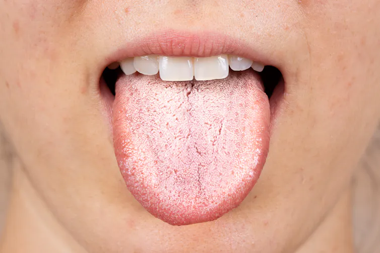 Dry mouth, bad breath and tooth damage: the effects Ozempic and Wegovy can have on your mouth