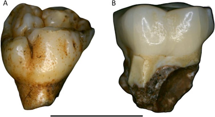 Photos of two teeth dimpled in small, even pits like the surface of a golf ball.