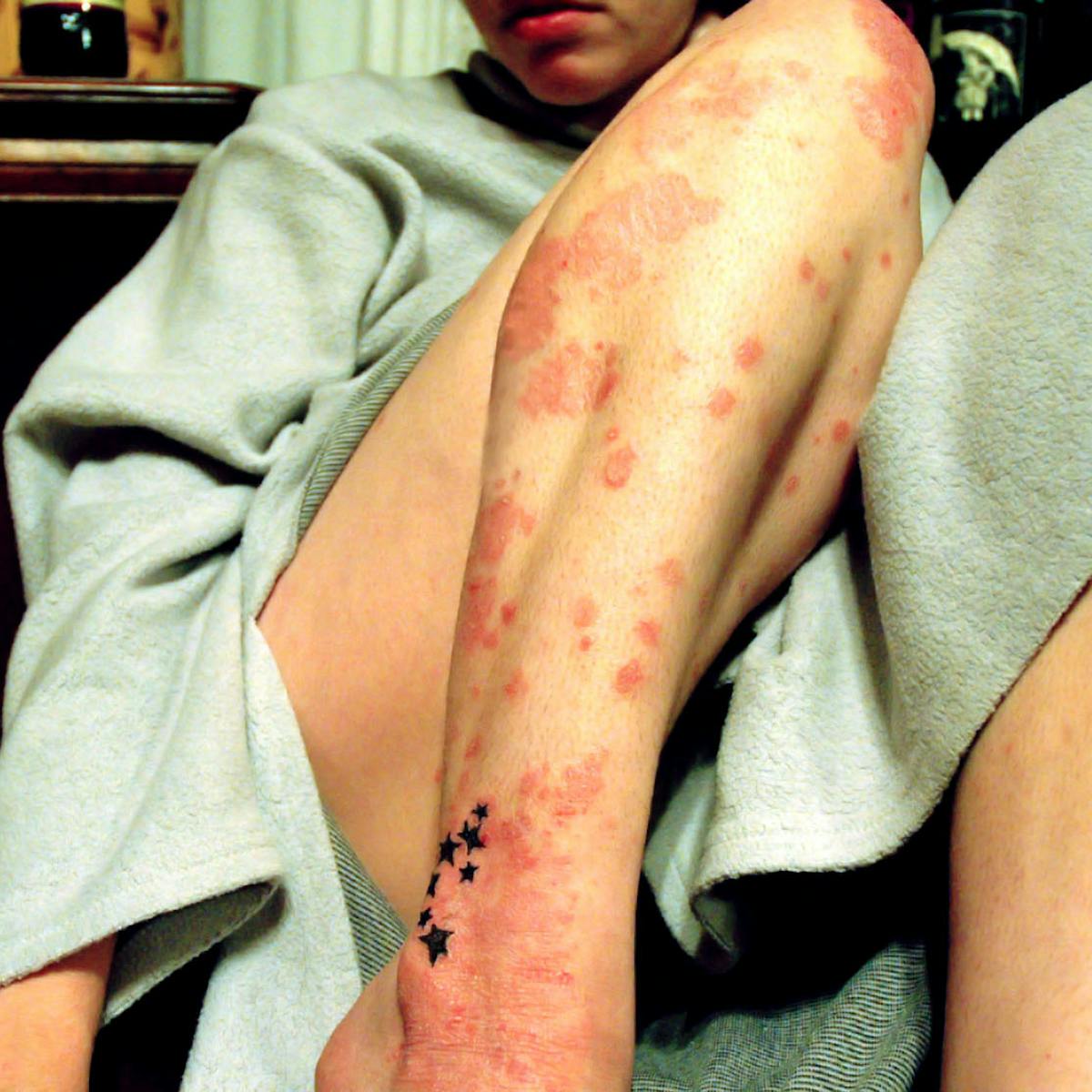 Explainer What Is Psoriasis