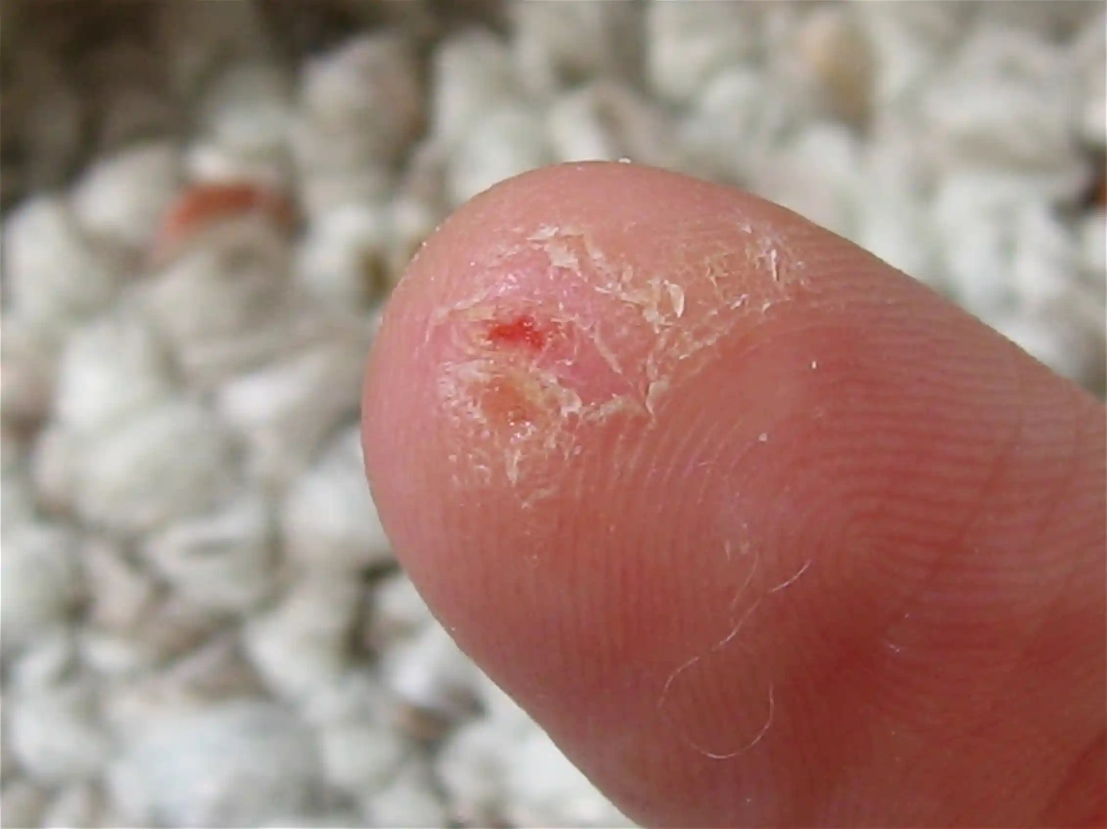 Explainer What Is Psoriasis