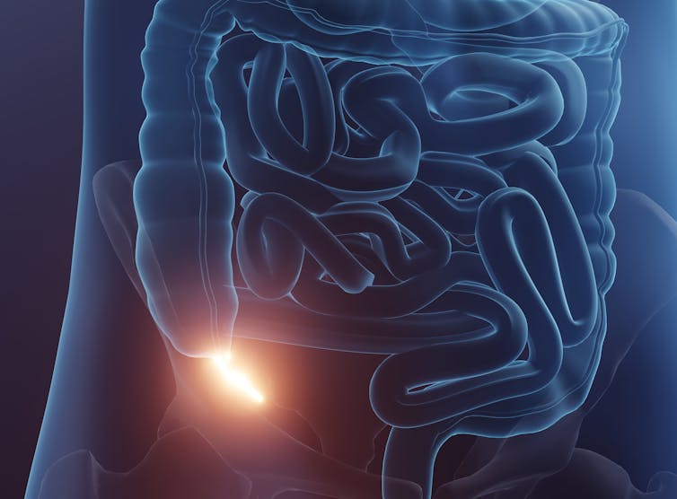 Why the appendix is much more important than we once thought - Modern ...