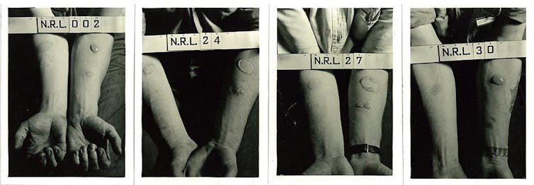 Four photos of people holding out their forearms, which have large blisters.