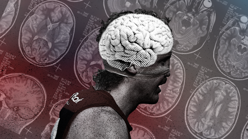 I’ve seen the brain damage contact sports can cause – we all need to take concussion and CTE more seriously