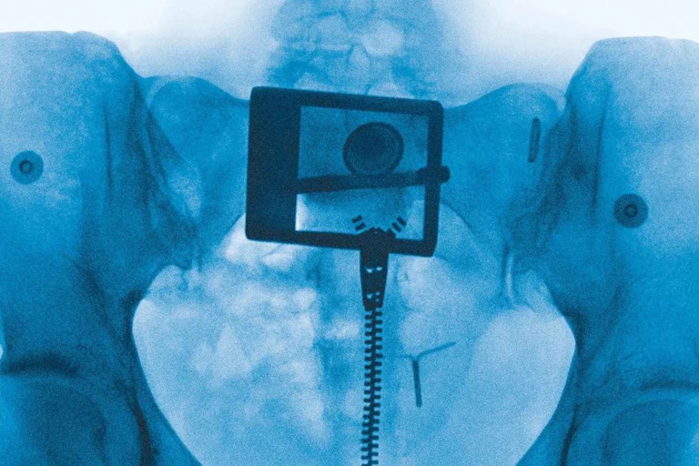 An X-ray of a pelvis showing an IUD and a belt buckle