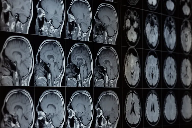 brain scans.