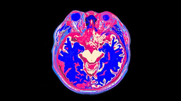 A brain scan showing various colors in different parts of the brain