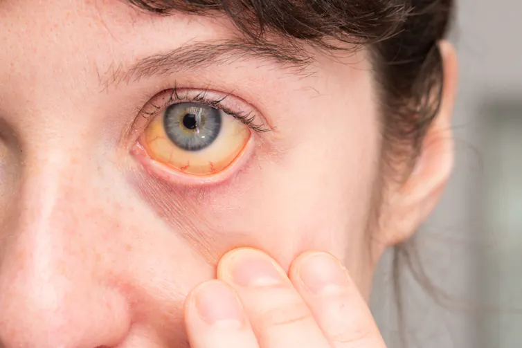 A person's yellow eye, showing signs of jaundice.