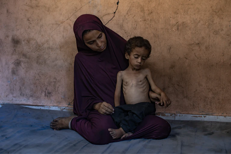 A Palestinian mother with her child who is suffering from malnutrition.