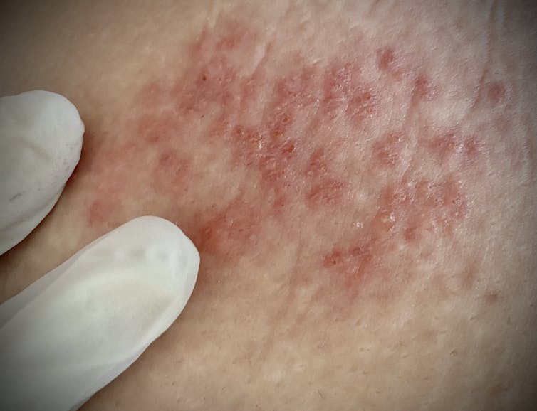 Red bumpy skin rash caused by shingles