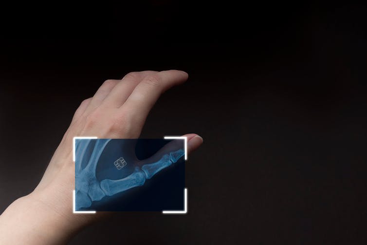 Hand with a section shown in X-ray with bones and a microchip visible