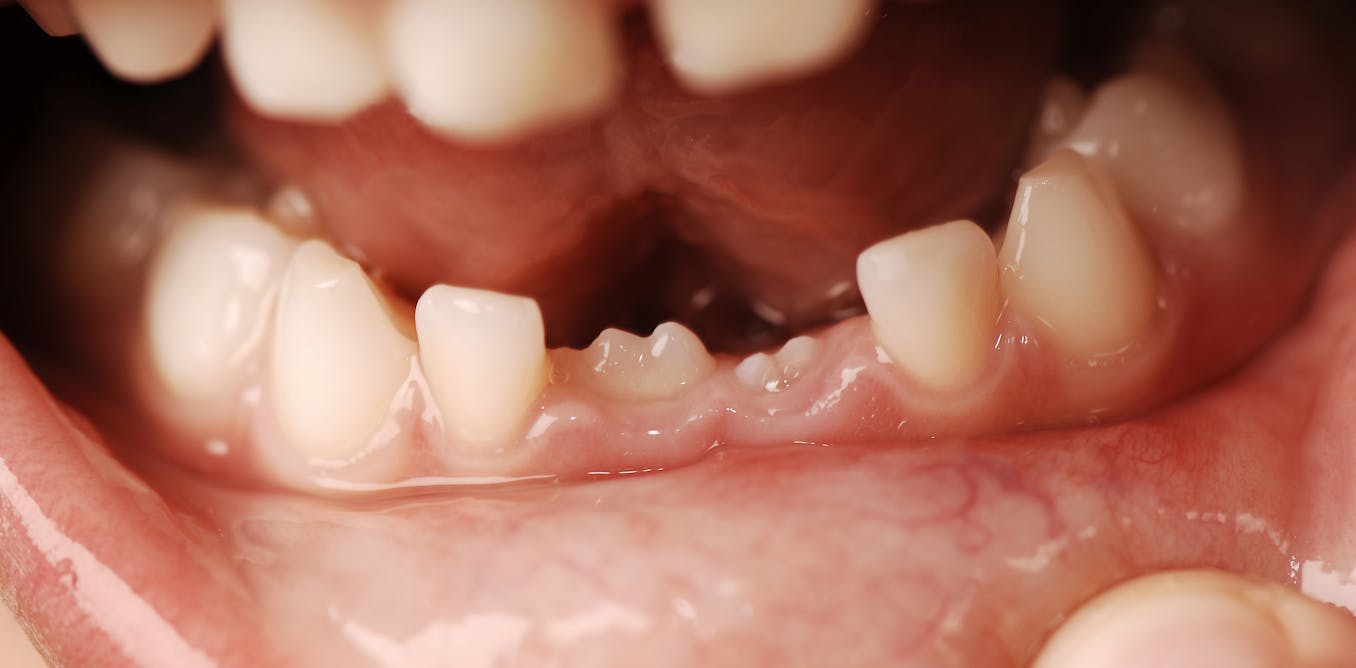 Why do people have baby teeth and adult teeth? Why do people have baby teeth and adult teeth?