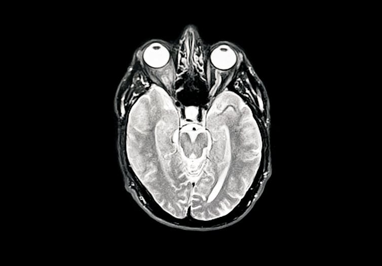 Brain image of early Alzheimer's disease