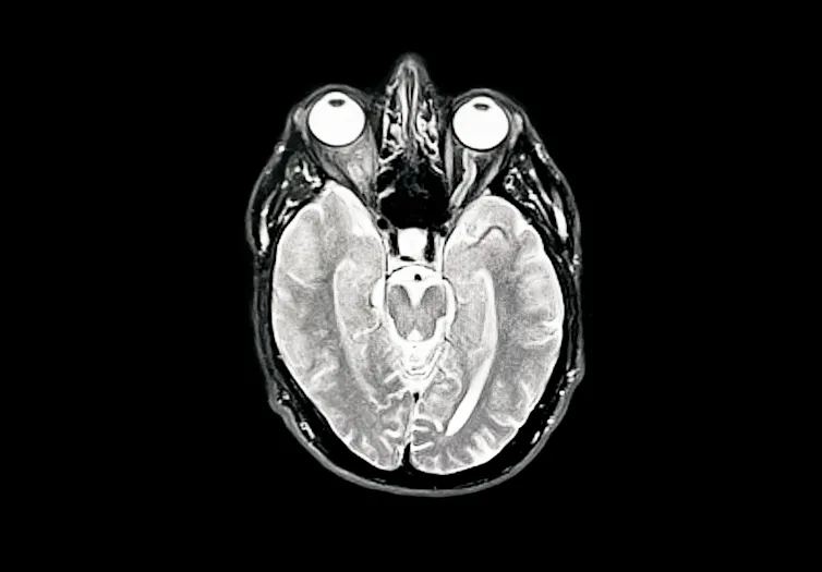 Brain image of early Alzheimer's disease