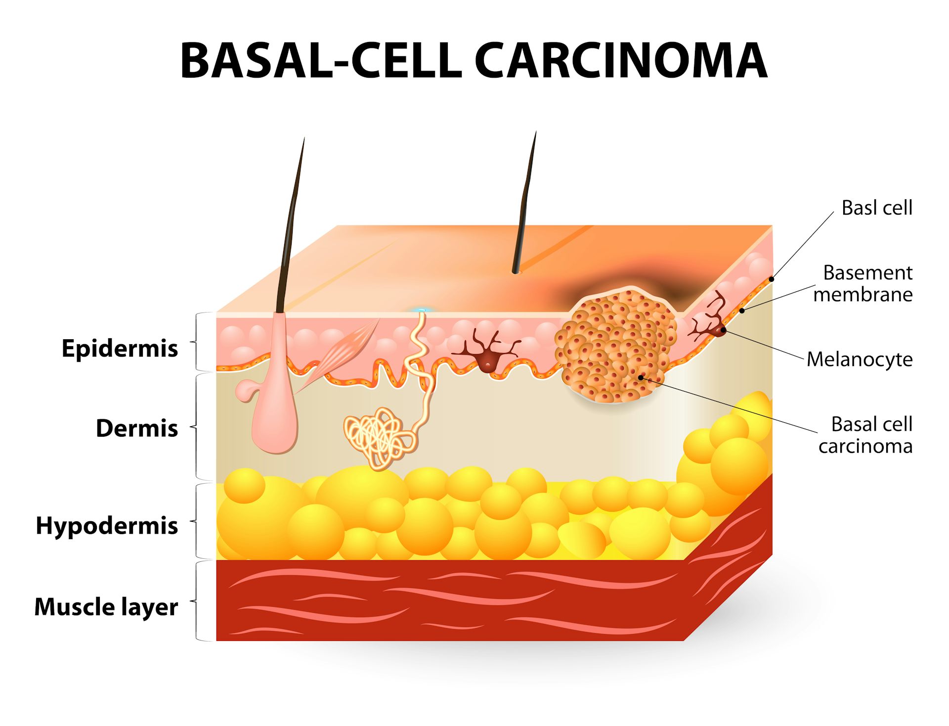 Sun Damage And Cancer How UV Radiation Affects Our Skin   Image 20150112 23792 1mncmn 