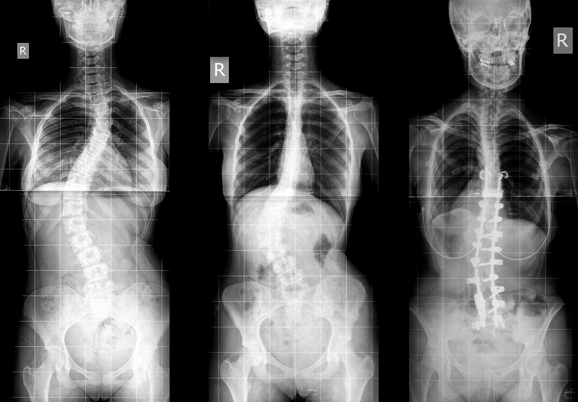 Three x-ray images of an extreme case of scoliosis, where the spine bends to the left.