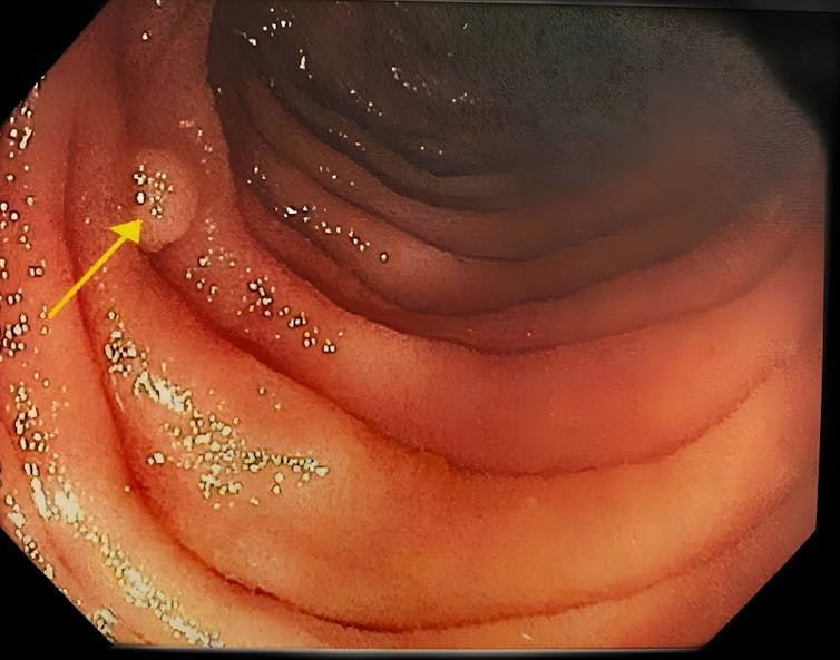 A yellow arrow pointing to a polyp in the large intestine.