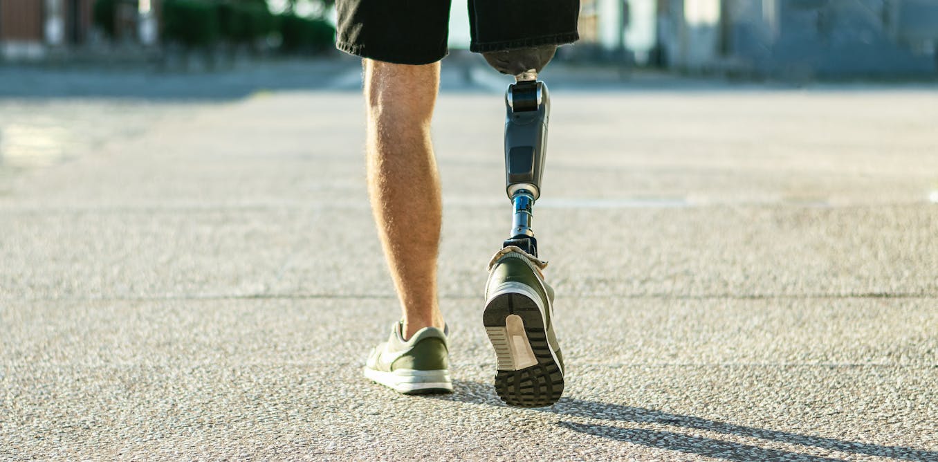 Scientists have been wrong about phantom limbs for decades – new study