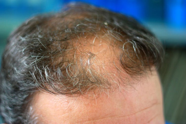 latest research male pattern baldness