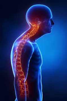 A picture depicting a man's spine which is curved due to kyphosis.